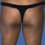 Brazilian Butt Lift Before & After Patient #8809