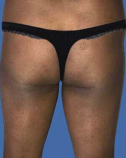 Brazilian Butt Lift Before & After Patient #8809