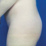 Brazilian Butt Lift Before & After Patient #8818