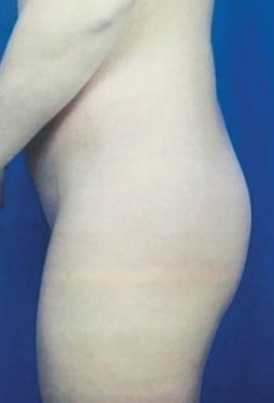 Brazilian Butt Lift Before & After Patient #8818