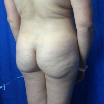 Brazilian Butt Lift Before & After Patient #7275