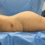 Brazilian Butt Lift Before & After Patient #8835