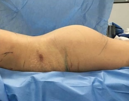 Brazilian Butt Lift Before & After Patient #8835