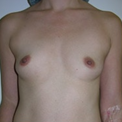 Breast Augmentation Before & After Patient #8845