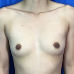 Breast Augmentation Before & After Patient #8874