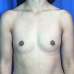 Breast Augmentation Before & After Patient #8881