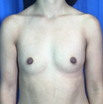 Breast Augmentation Before & After Patient #8881