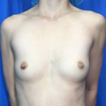Breast Augmentation Before & After Patient #8888
