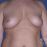 Breast Lift / Mannequin Breast Lift Before & After Patient #8934