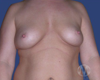Breast Lift / Mannequin Breast Lift Before & After Patient #8934