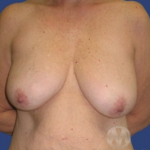 Breast Lift / Mannequin Breast Lift Before & After Patient #8946