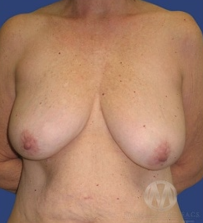 Breast Lift / Mannequin Breast Lift Before & After Patient #8946