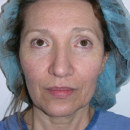 Blepharoplasty (Eyelid Surgery) Before & After Patient #8980