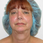 Facelift and Necklift Before & After Patient #9017