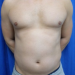 Liposuction Before & After Patient #7926