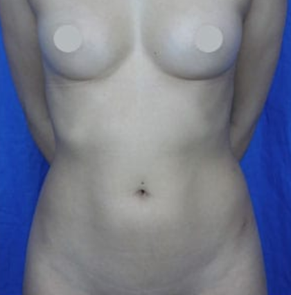 Liposuction Before & After Patient #7946