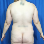 Liposuction Before & After Patient #7955
