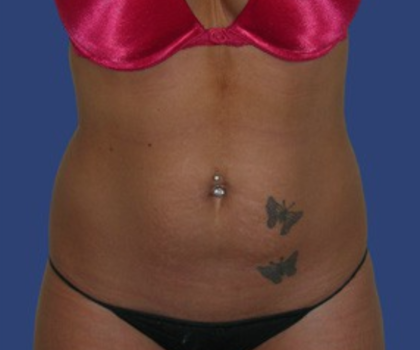Liposuction Before & After Patient #8046