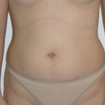 Liposuction Before & After Patient #8066