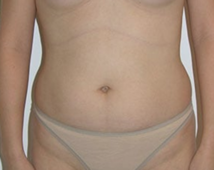 Liposuction Before & After Patient #8066