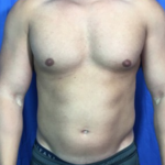 Liposuction Before & After Patient #9083