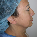 Facelift and Necklift Before & After Patient #7811
