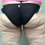 Thigh Lift Before & After Patient #8098