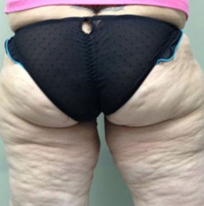 Thigh Lift Before & After Patient #8098