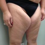 Thigh Lift Before & After Patient #8105
