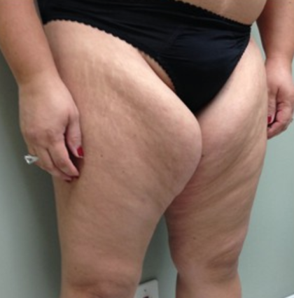 Thigh Lift Before & After Patient #8105