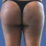 Brazilian Butt Lift Before & After Patient #8809