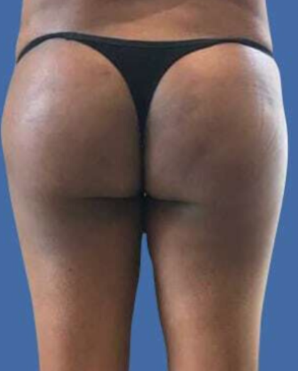 Brazilian Butt Lift Before & After Patient #8809