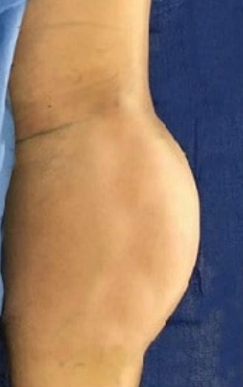 Brazilian Butt Lift Before & After Patient #8818