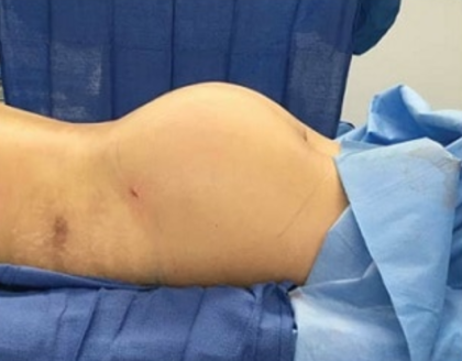 Brazilian Butt Lift Before & After Patient #8835