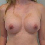 Breast Augmentation Before & After Patient #8845