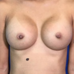 Breast Augmentation Before & After Patient #8859