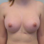 Breast Augmentation Before & After Patient #8895