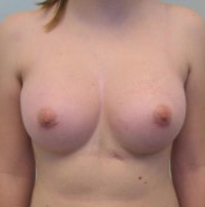 Breast Augmentation Before & After Patient #8895