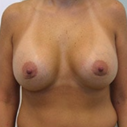 Breast Augmentation Before & After Patient #8902