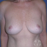 Breast Lift / Mannequin Breast Lift Before & After Patient #8946