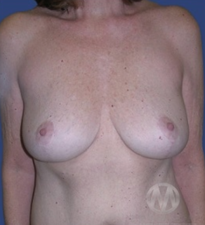 Breast Lift / Mannequin Breast Lift Before & After Patient #8946