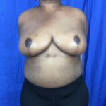 Breast Lift / Mannequin Breast Lift Before & After Patient #8959