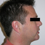Chin Augmentation Before & After Patient #8975