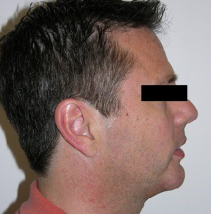 Chin Augmentation Before & After Patient #8975