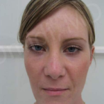 Blepharoplasty (Eyelid Surgery) Before & After Patient #8995