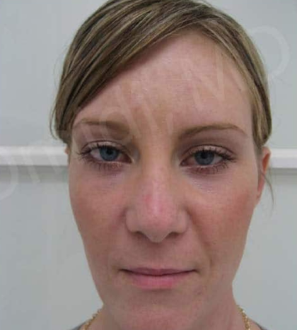 Blepharoplasty (Eyelid Surgery) Before & After Patient #8995