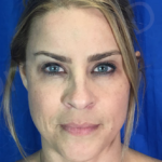 Blepharoplasty (Eyelid Surgery) Before & After Patient #8998