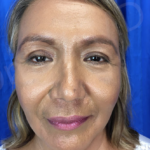 Blepharoplasty (Eyelid Surgery) Before & After Patient #9001