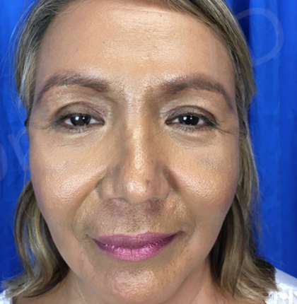 Blepharoplasty (Eyelid Surgery) Before & After Patient #9001
