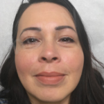 Blepharoplasty (Eyelid Surgery) Before & After Patient #9006